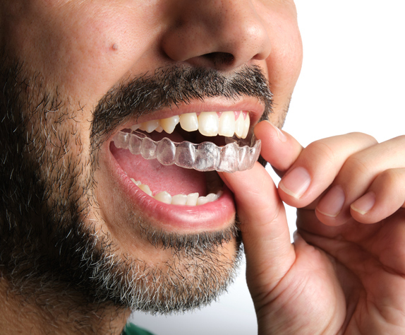 Close up of a man with Invisalign for adults inserting his Invisalign tray
