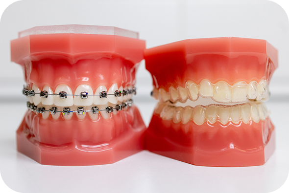 A dental model with braces adjacent to a dental model with Invisalign clear aligners