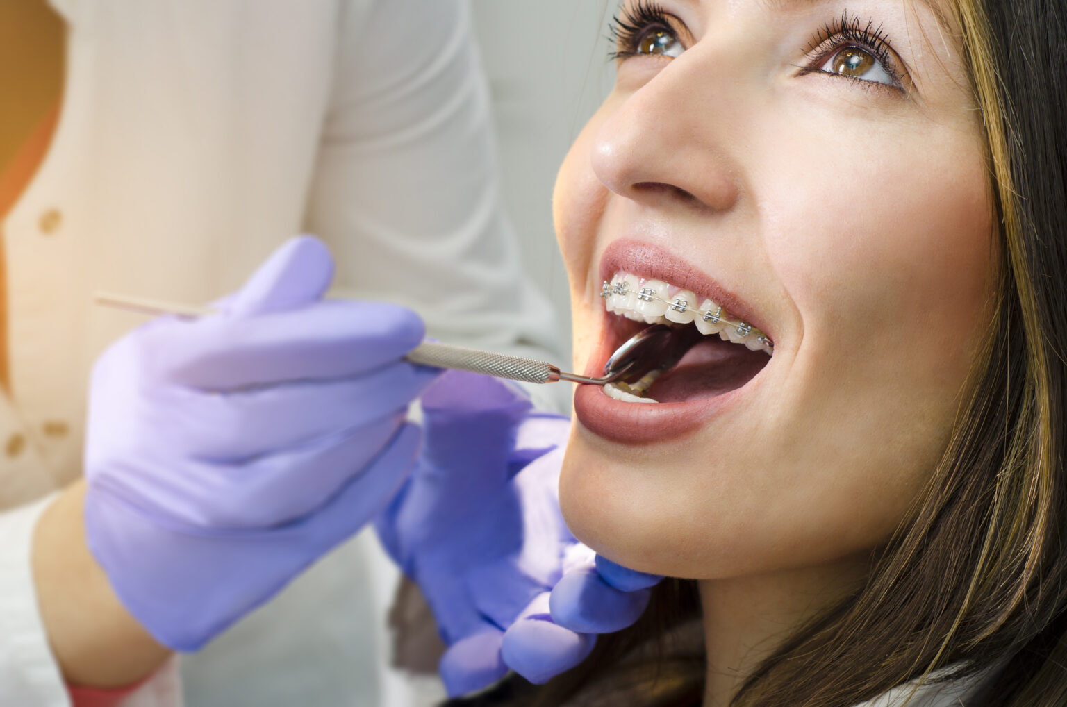 Woman with braces for adults smiling while her orthodontist examines the back of her teeth