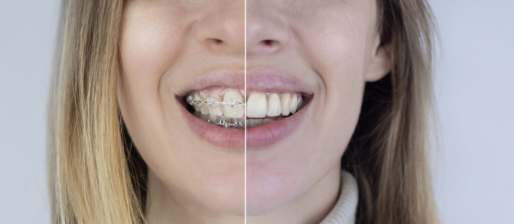 Split comparison of a woman’s smile with and without braces